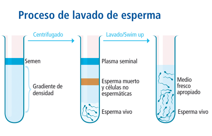 Ilustración: Proceso de lavado de esperma